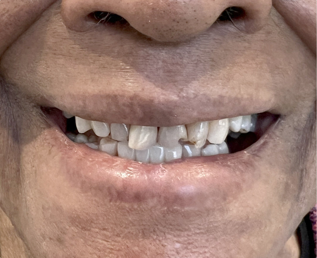 Close-up of a person's mouth showing teeth, lips, and skin texture pre treatment.