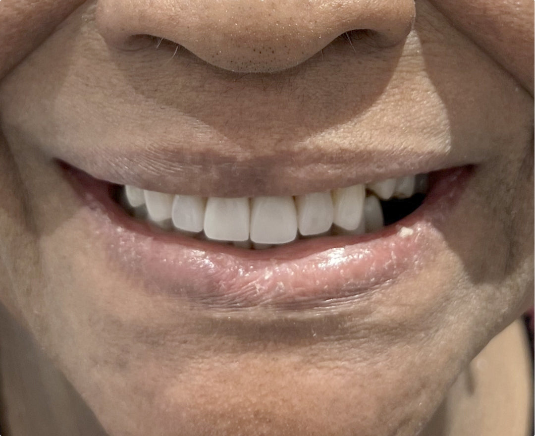 Close-up of a person's mouth showing white teeth and pink lips, with the surrounding skin filling the frame post treatment.